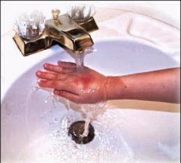 First Aid for Burns – how to reduce pain and scarring