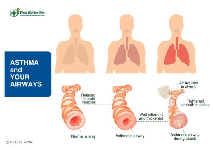 asthma