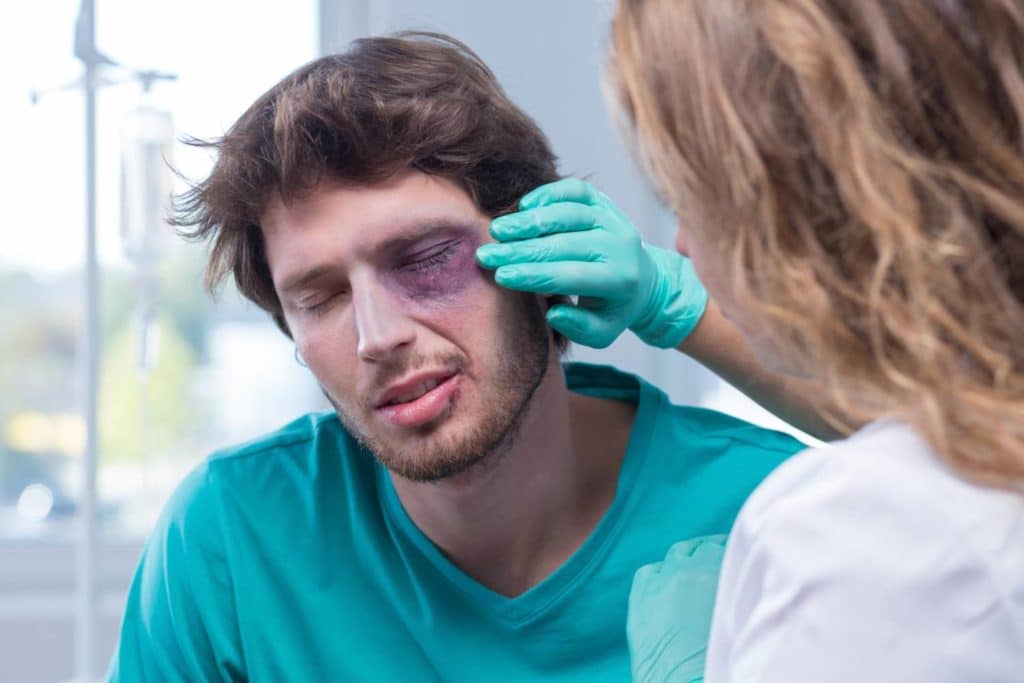man with black eye