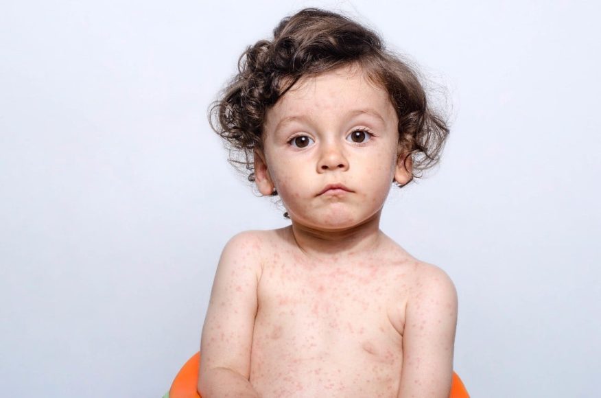 How to recognise and treat mumps, measles, scarlet fever and hand foot and mouth