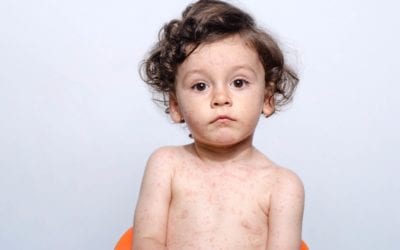 Measles – The Outbreak You Need to Know About
