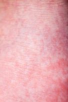 scarlet fever rash
