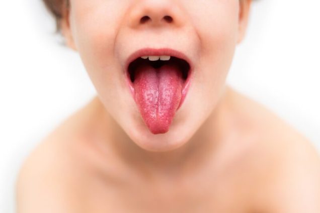 Scarlet fever strawberry tongue