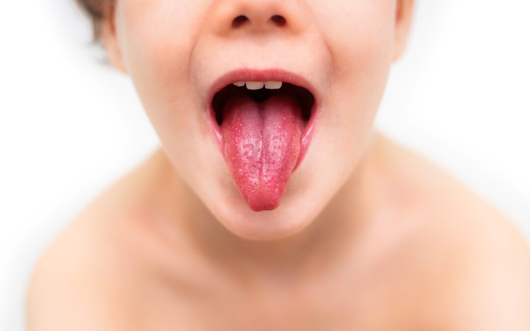 Scarlet Fever and Streptococcal Infections – What Are They?