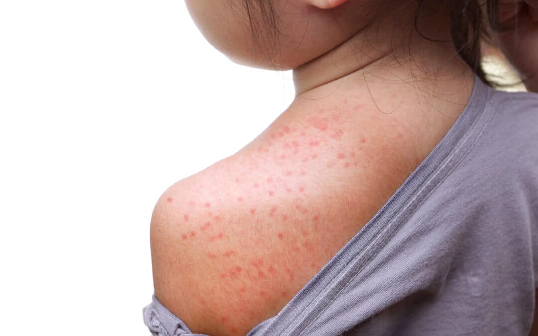 Recognising Mumps, Measles and Hand Foot and Mouth Disease