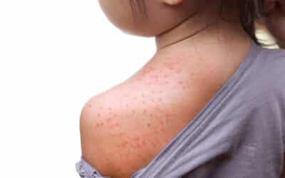 Recognising Mumps, Measles and Hand Foot and Mouth Disease