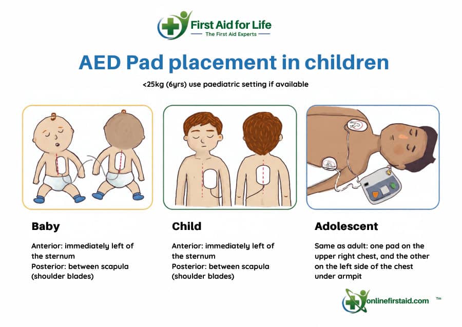AED Pad Placement in Children poster