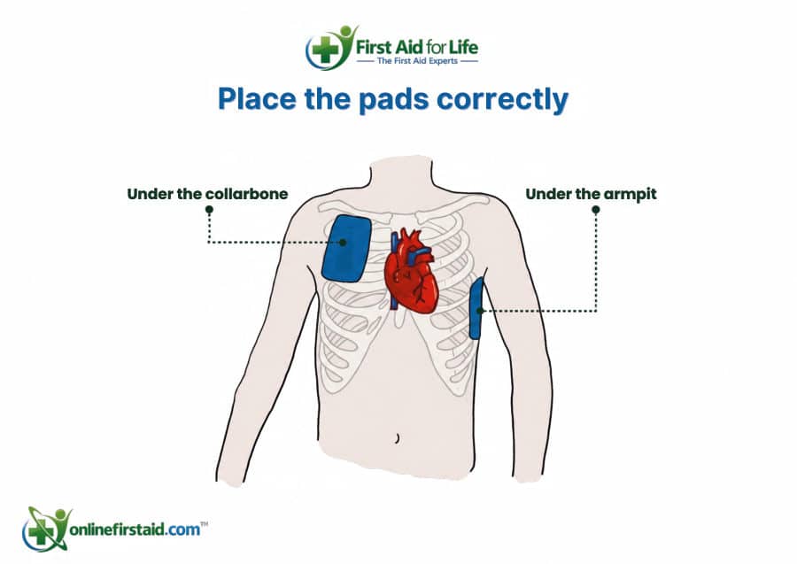 AED Pad Placement: Men poster