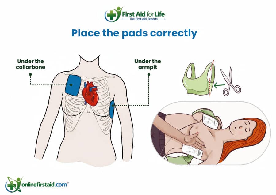 AED Pad Placement: Women poster