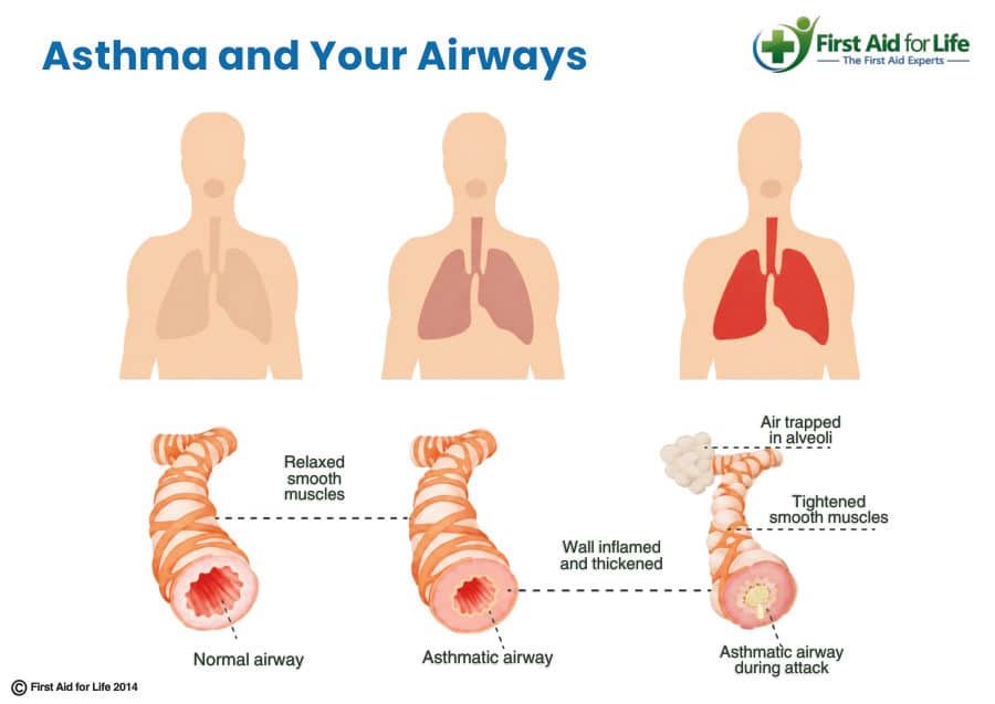 Asthma and Your Airways poster