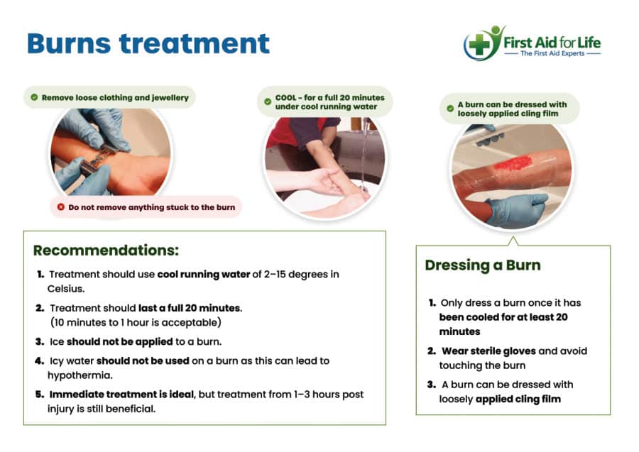 Burns Treatment poster